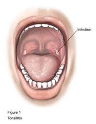 Tonsillectomy Adult The Holly Private Hospital Essex