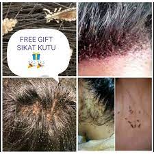 Obat kutu rambut, kota malang. Buy Ubat Kutu Power Spray Kutu Kepala Organik Kutu Rambut Ubat Kutu Kepala Organik Spray Kutu Rambut Selamat Dan Berkesan Seetracker Malaysia