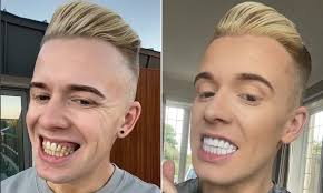 I had teeth implants in Turkey