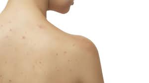 Perenang gatal atau dermatitis serkaria juga menjadi penyebab bintik merah pada kulit. Bintik Merah Pada Kulit Tidak Gatal Ini 10 Penyebabnya
