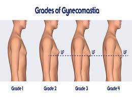 Gynecomastia and how to treat it. Gynecomastia Alert Do S And Don Ts Before Male Breast Reduction Surgery Business Standard News
