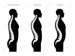 A06031 seatalk ng terminators (qty. Spinal Deformity Flat Vector Illustration Kyphosis Lordosis Royalty Free Cliparts Vectors And Stock Illustration Image 146206206