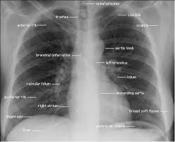 Check spelling or type a new query. Chest X Rays Aka Cxr Are One Of The Most Basic Imaging Studies Done In Medicine Almost Every Hospitalize Radiology Student Medical Knowledge Medical Anatomy