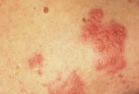 It's going to take some time for your newborn to get used to their new surroundings. Picture Of Shingles Herpes Zoster
