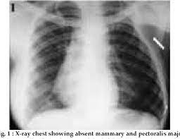 Poland syndrome is a rare condition that is evident at birth (congenital). Figure 1 From Poland Syndrome With A Rare Association Semantic Scholar