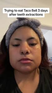 I got tired of mashed potatoes 🙃 #fyp #foryou #foryoupage  #wisdomteethremoval #wisdomteethaftermath