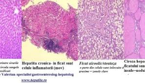 Cel mai periculos tip de virus din cele 5 tulpini de virus hepatic, care are consecințe pe. Viremia In Hepatita Valori Normale Mari Mici 0758751841 Cabinet De Gastroenterologie Si Hepatologie Bucuresti 0758751841 Cabinet De Gastroenterologie Si Hepatologie Bucuresti