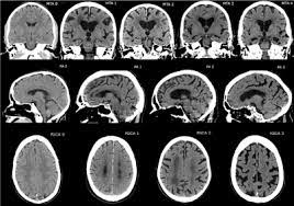 Cerebral Atrophy Wikipedia