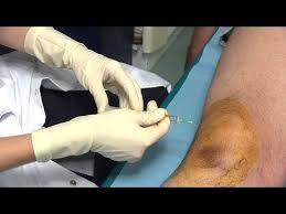 J'ai 39 ans et je fais depuis 20 ans deux à trois heures de sport par semaine (vélo, piscine, musculation). Douleurs Articulaires Quelles Solutions Les Infiltrations Allo Docteurs Youtube