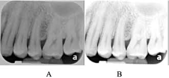 Radiographic Density The Radiographic Image Continuing Education Course Dentalcare Com