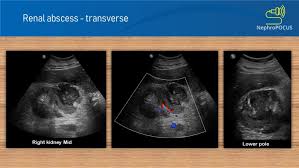 Image result for Perinephric Abscess