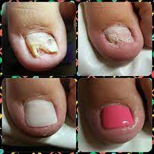 Lcn Toe Nail Reconstruction From Lcn Toscana Toe Nails Wedding Acrylic Nails Pink Acrylic Nails