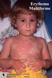 Image result for Erythema Multiforme Major