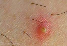 Ingrown facial hair removal can be some time be hectic and very complicated to some people. The Waxologist Guide To Ingrown Hair Waxing Salon Brazilian Hollywood Manchester Cheshire