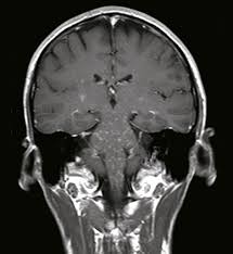 People with kfs are born with abnormal fusion of at least two spinal bones (vertebrae) in the neck. Der Gepfefferte Hirnstamm