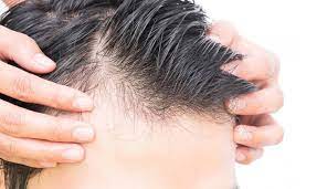 Masalah rambut gugur adalah mimpi ngeri bagi setiap wanita. Petua Atasi Rambut Gugur Bersepah Di Lantai Cara Untuk Elak Botak Sebelum Usia Maskulin