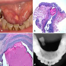 Image result for Sialolithiasis