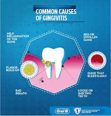 But not all gingivitis leads to periodontitis. What Is Gingivitis Symptoms Causes And Treatments Oral B