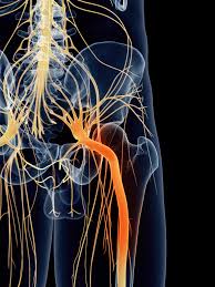 Image result for Sciatica