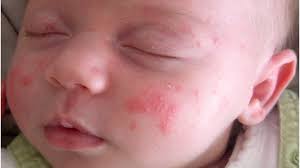 Eczema in babies is usually different than eczema in older children and adults. Newborn Skin Rash Understanding The Mystery Behind Newborn Eczema