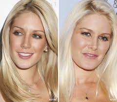 Chin Implant Before After Pics Celebs With Sharp Jawline