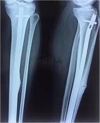 Image result for Tibia Stress Fracture