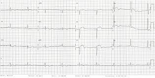 Ein ekg kann veränderungen und entzündungen aufzeigen, sowie die herzmuskelentzündung lokalisieren. Ekg Bei Perikarditis Fokus Ekg