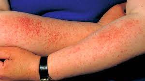 These symptoms typically develop within minutes to hours after sun exposure. Sun Rash Poisoning Allergy Treatment Causes Pictures And More
