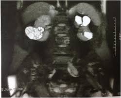 The ultrasonographic (us) appearance of hydatid cysts may vary. Medical Treatment For An Isolated Renal Multilocular Hydatid Cyst In An Elderly A Case Report Bmc Nephrology Full Text