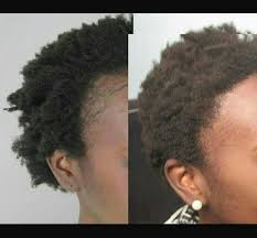 Type 4 has the highest susceptibility to experience natural hair breakage. Is Your Hairline Thinning Or Breaking Are Natural Hair Kenya ÙÙŠØ³Ø¨ÙˆÙƒ