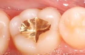 Amalgamvergiftung Nebenwirkungen Von Amalgam Symptome