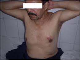 Fortunately, breast cancer in men is very rare. Left Male Breast Cancer Presenting With Breast Lump Scar Of Biopsy Is Download Scientific Diagram
