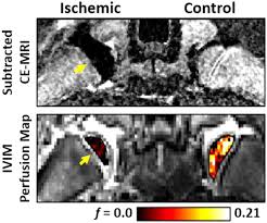 Image result for Perthes Test