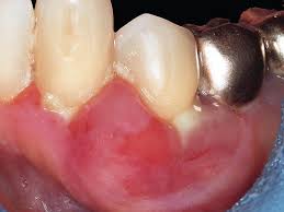 Image result for Periodontal Abscess