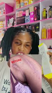 Happy Event for Stretch Marks at Clicks