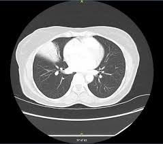 Image result for Air Bronchogram