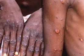 First cases of rare infection diagnosed in uk one was a nigerian resident in cornwall, followed by the case at the blackpool victoria hospital. What Is Monkeypox Where Did The Disease Come From And How Did It Get To The Uk Express Co Uk