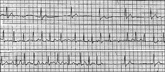 Sick Sinus Syndrome Sss Bradycardia Tachycardia Syndrome Healthengine Blog