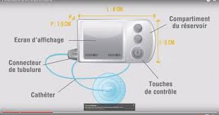 Type 2 diabetes is a chronic disease. La Pompe A Insuline Federation Francaise Des Diabetiques