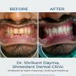 professional teeth cleaning and Polishing