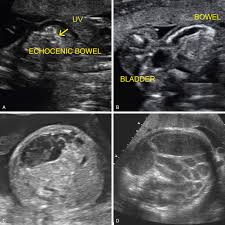 Ultrasound Evaluation Of The Fetal Gastrointestinal Tract And Abdominal Wall Radiology Key
