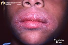 So although their appearance may be alarming, they're not associated with skin cancer. Chronic Lip Licking Exfoliative Cheilitis Academic Dermatology Of Nevada