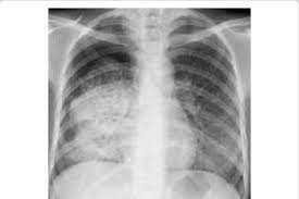 Chest X Ray Showing Dense Homogenous Opacity In Right Middle And Lower Download Scientific Diagram