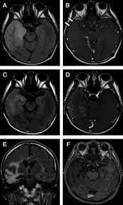 In children older than 3 months and in adults brain biopsy: Movement Disorders In An Adult Patient With Anti Nmdar Encephalitis After Herpes Simplex Encephalitis Tay 2017 Movement Disorders Clinical Practice Wiley Online Library