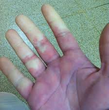 My Hands And Feet Are Always Cold Should I Worry Always Cold Cold Body Condition