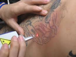 People often ask, can a permanent tattoo be removed? Laser Tattoo Removal Professional Hair Removal In Vietnam