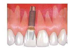 More than half of all orthopaedic implants may be detected by metal detectors. Professional Dental Implants Lemont Dental Clinic