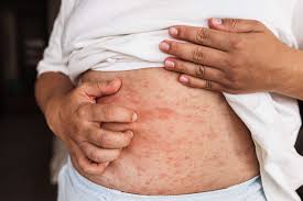 Image result for allergy rash on the legs