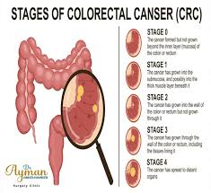 Image result for blood in stool human poop