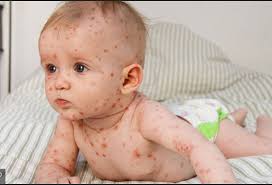 25 Years of Varicella Vaccination Program in the United States: Health and  Economic Impact during 1995–2019